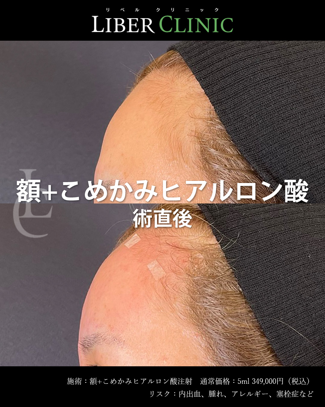 手術前と術直後