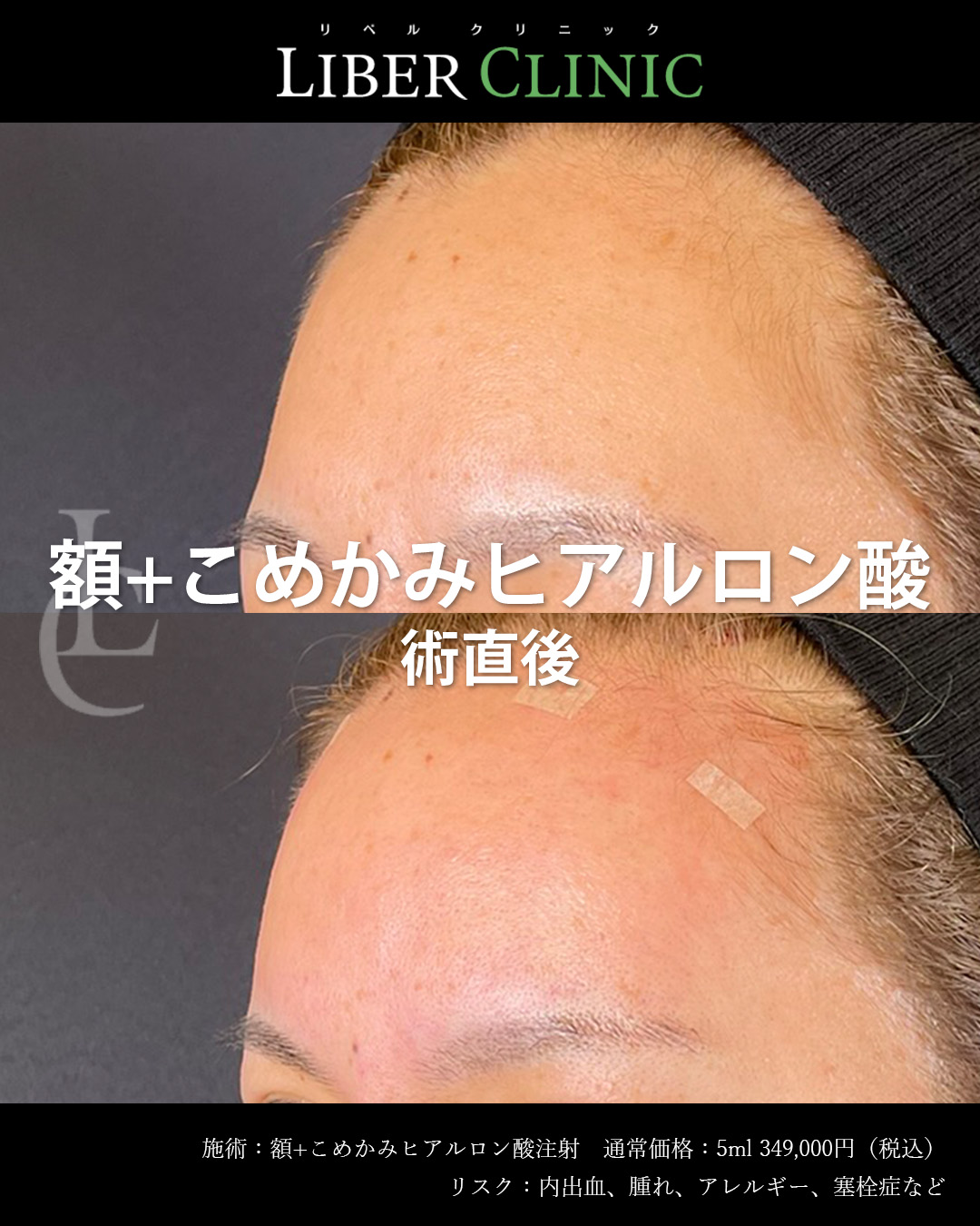 手術前と術直後