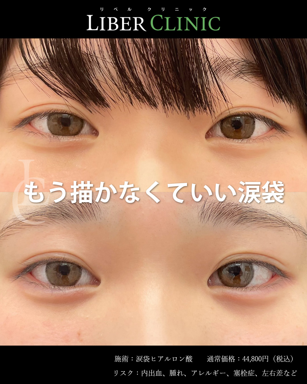 もう描かなくていい涙袋