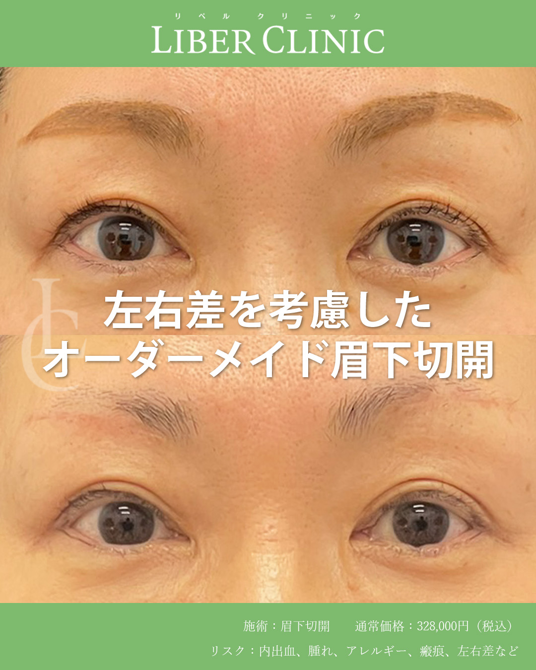左右差を考慮したオーダーメイド眉下切開