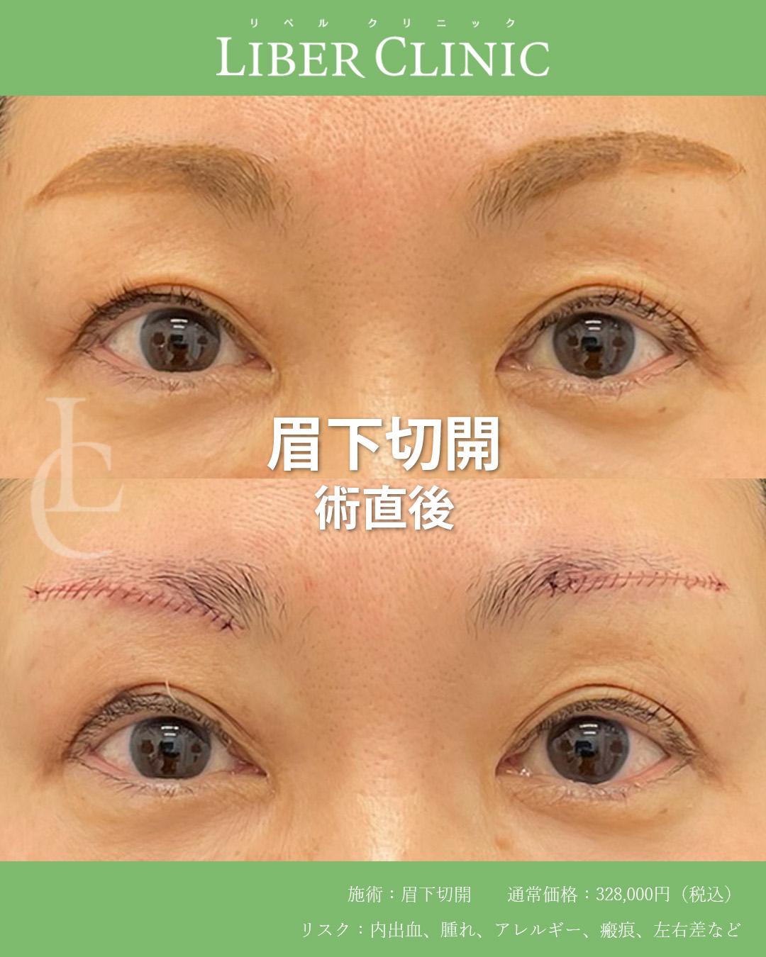 手術前と術直後