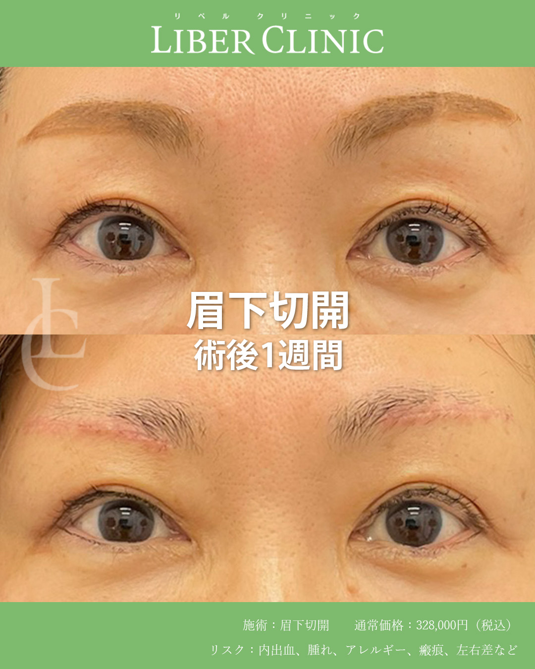 手術前と術後1週間