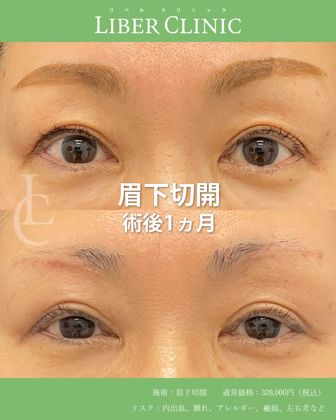 手術前と術後1ヵ月