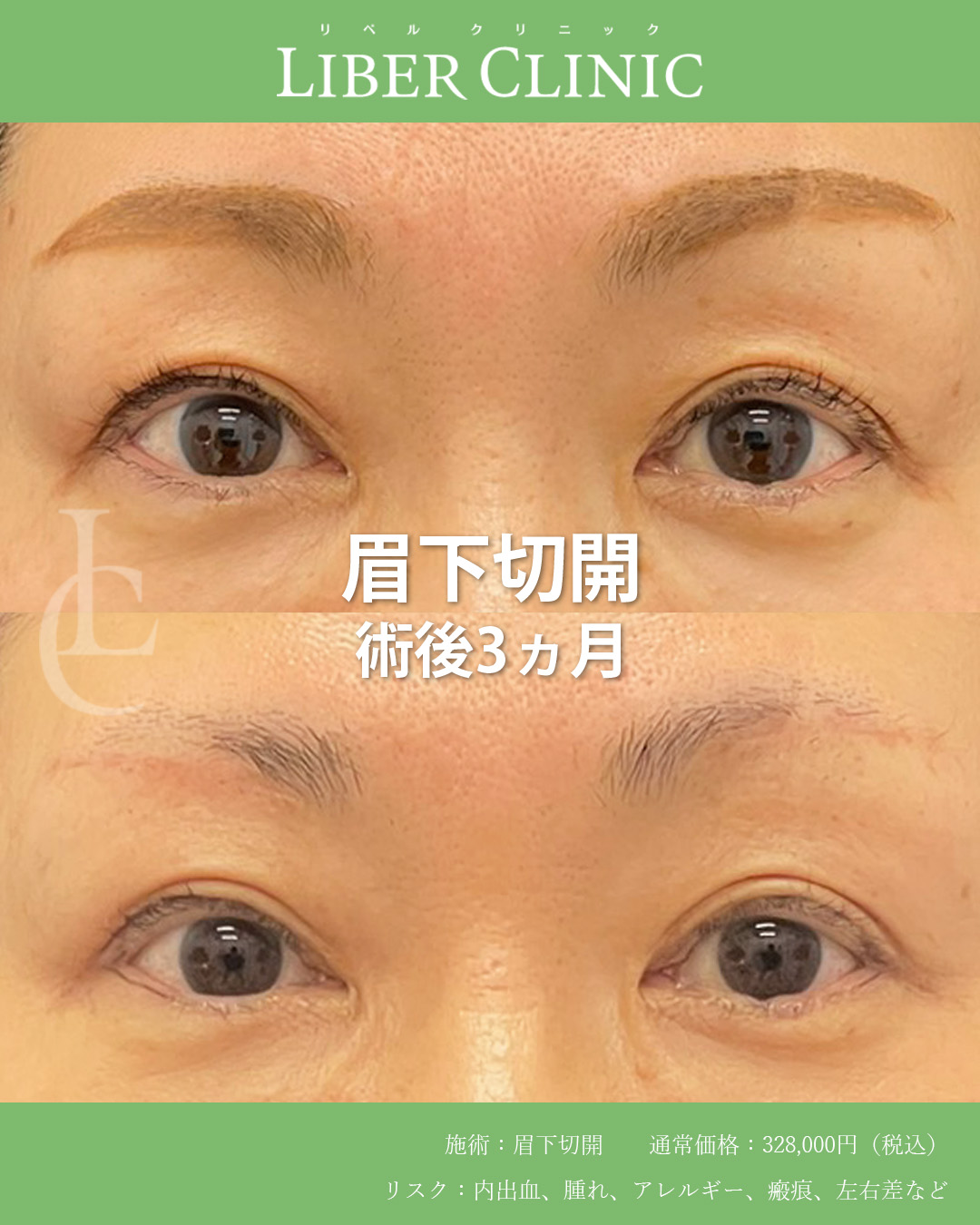 手術前と術後3ヵ月