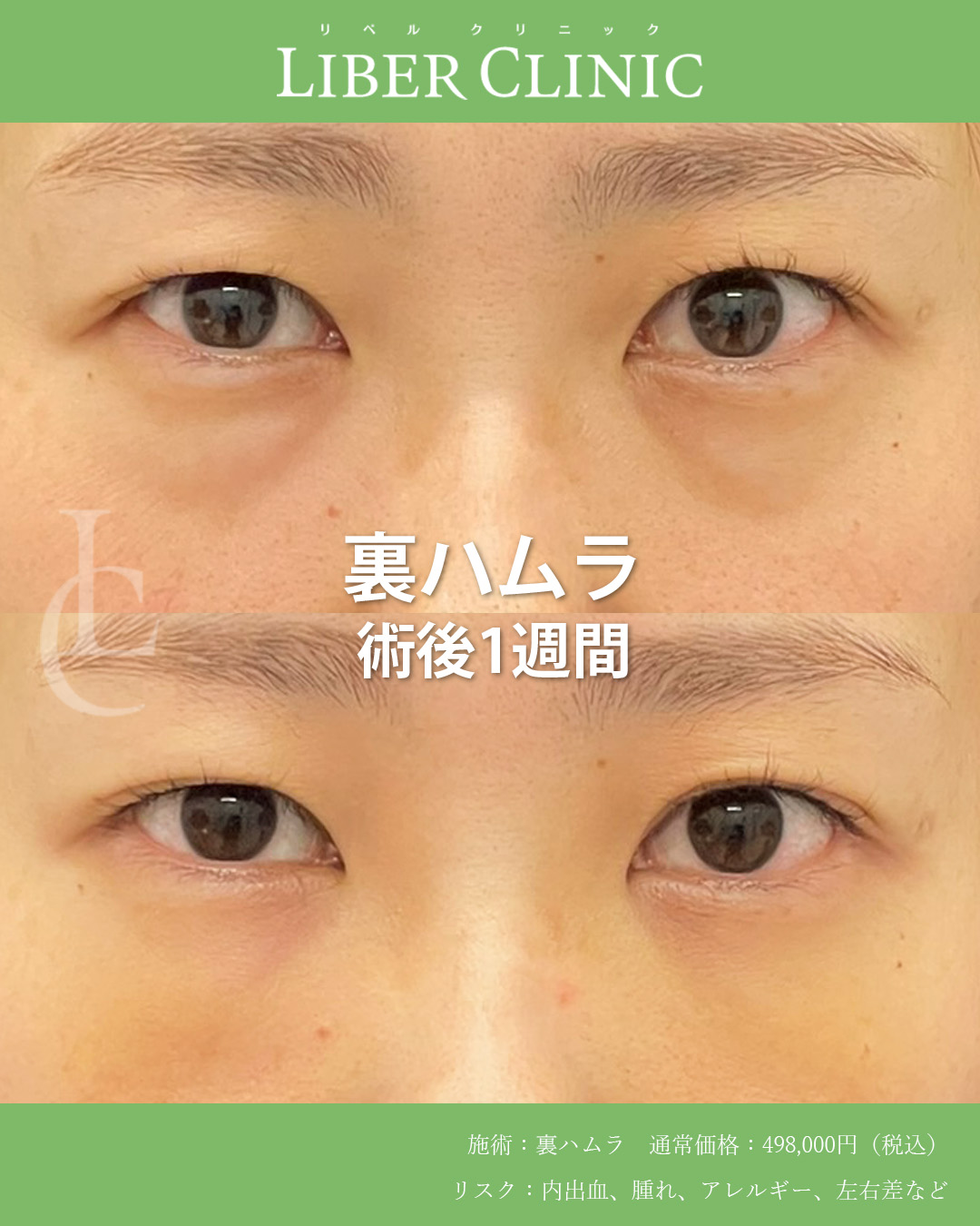 手術前と術後1週間