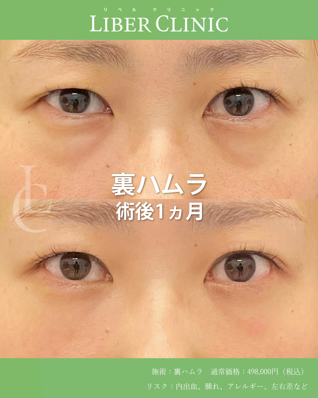 手術前と術後1ヵ月