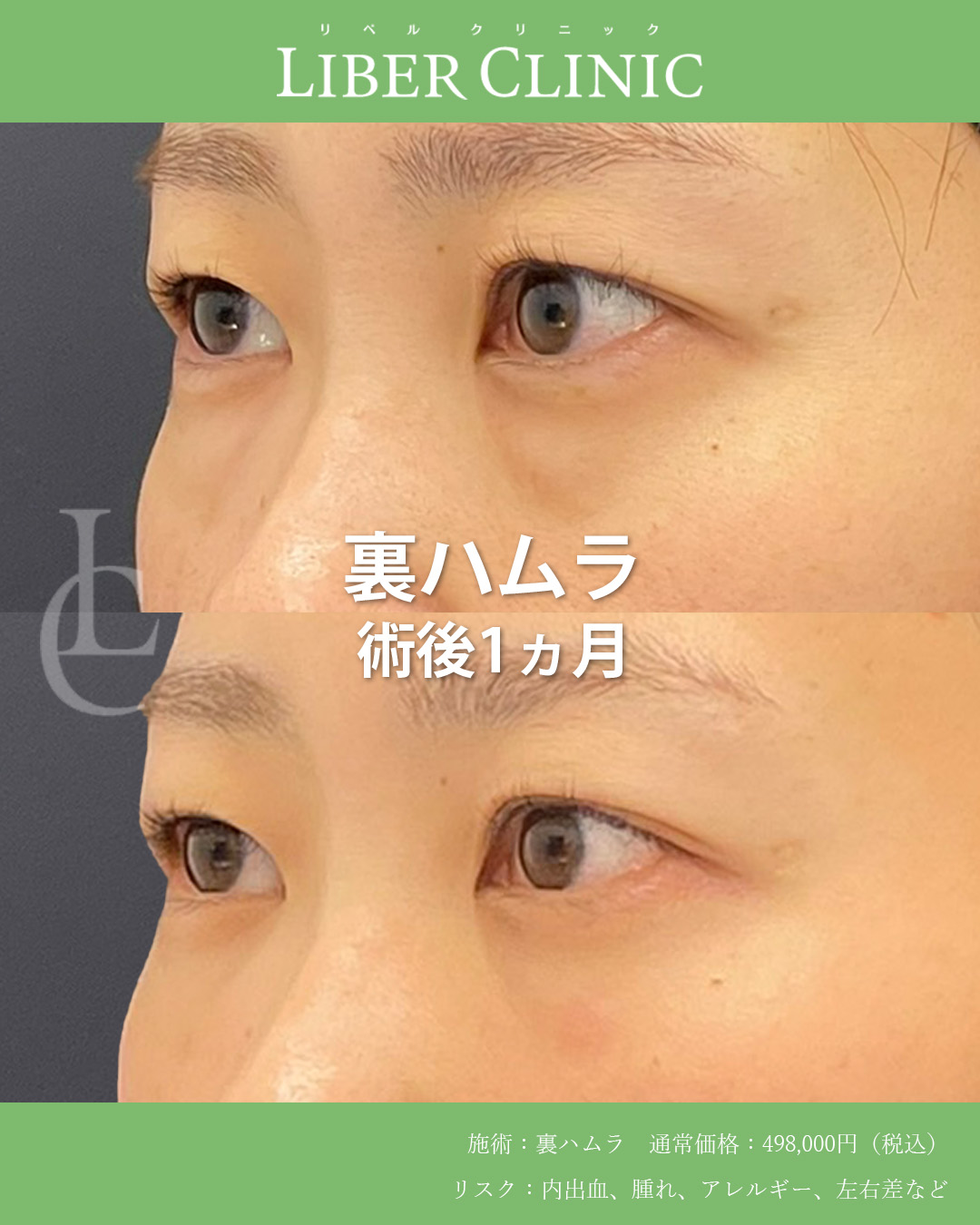 手術前と術後1ヵ月