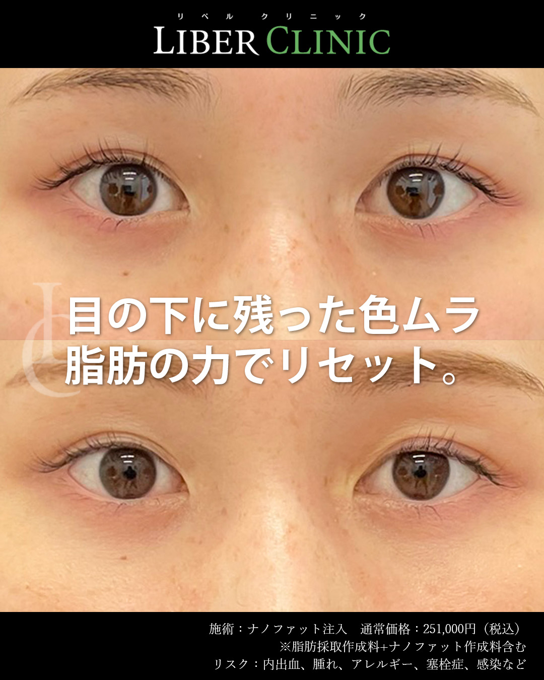 目の下に残った色ムラ脂肪の力でリセット