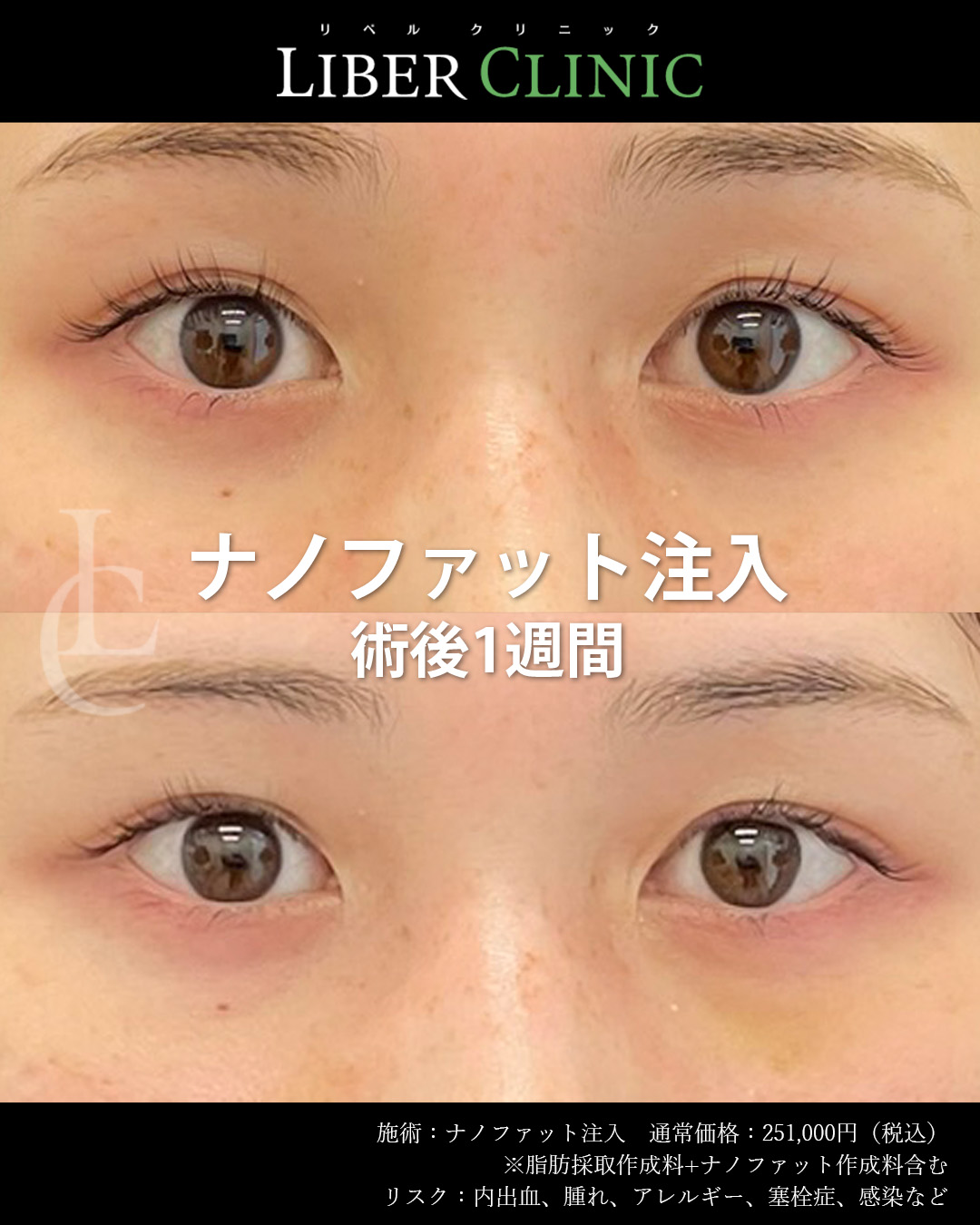 手術前と術後1週間