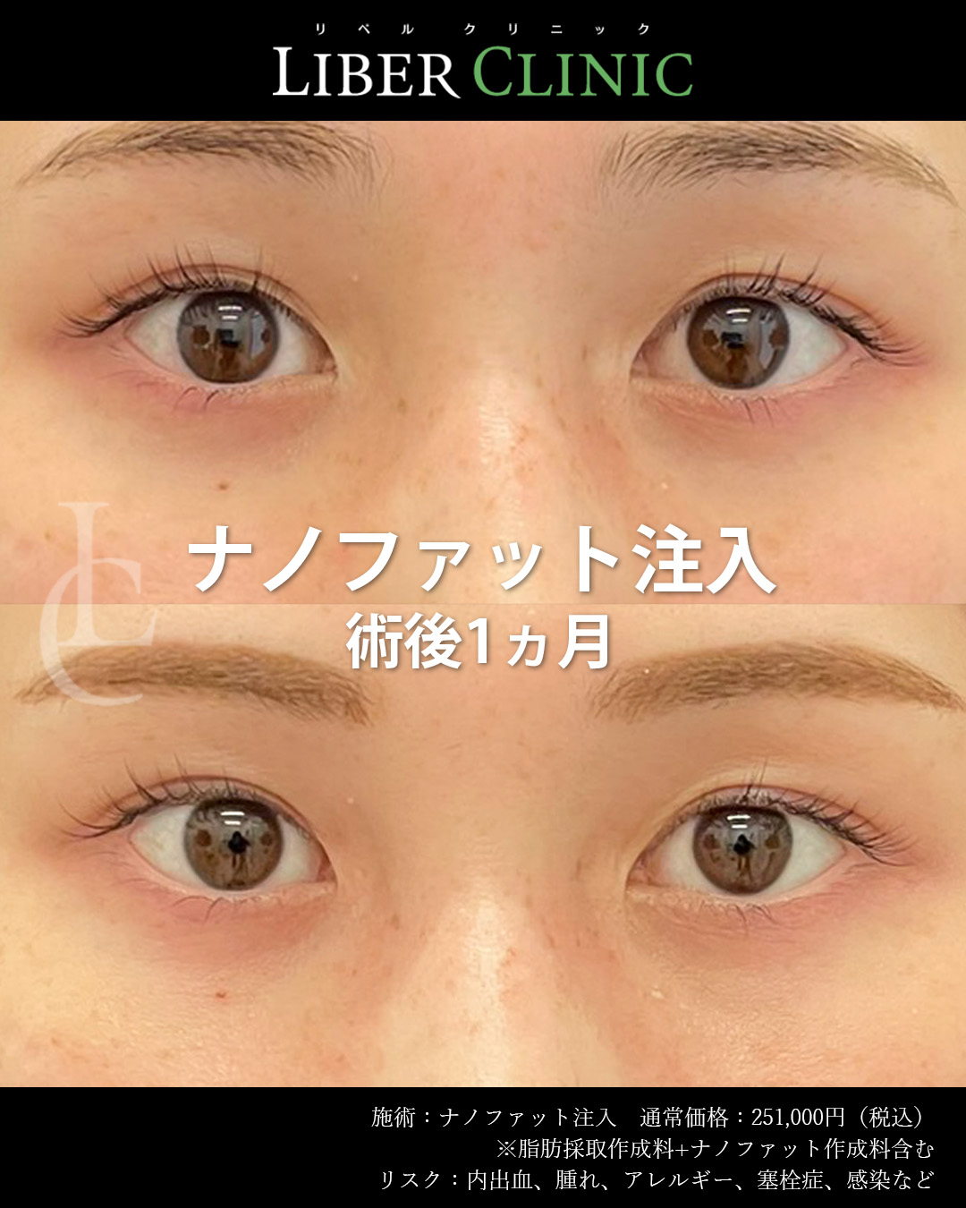 手術前と術後1ヵ月