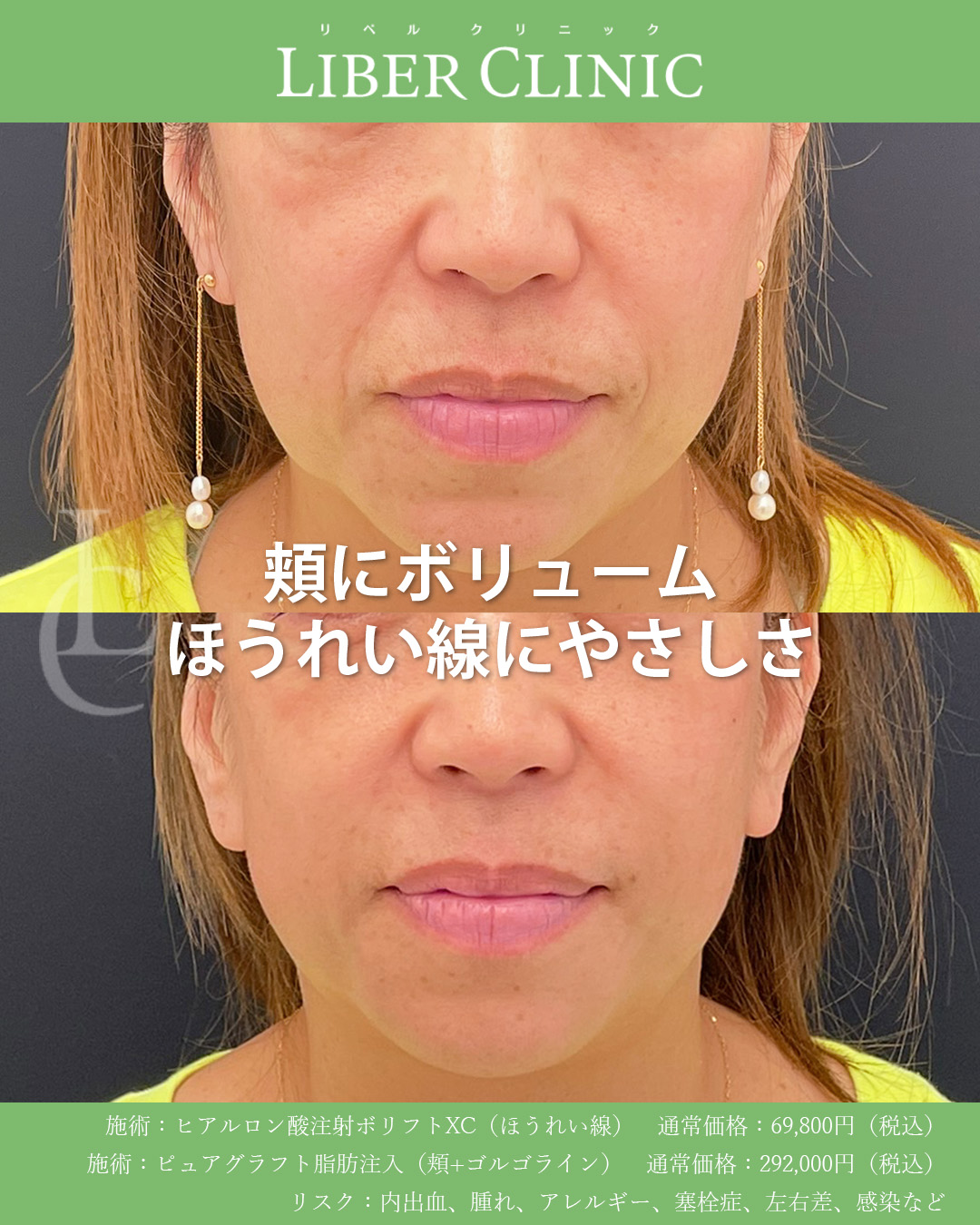 脂肪注入とヒアルロン酸注射の組み合わせ