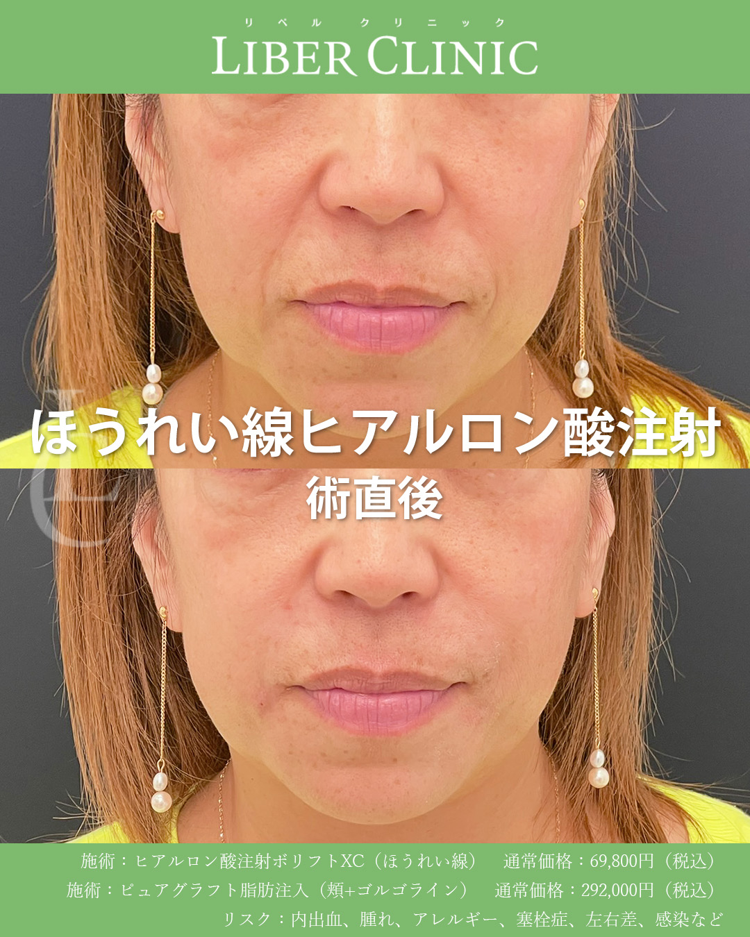 ほうれい線ヒアルロン酸注射　手術前と術直後