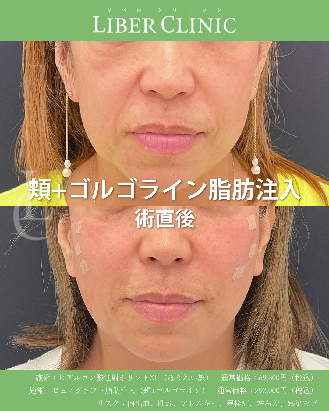 頬+ゴルゴライン脂肪注入　手術前と術直後