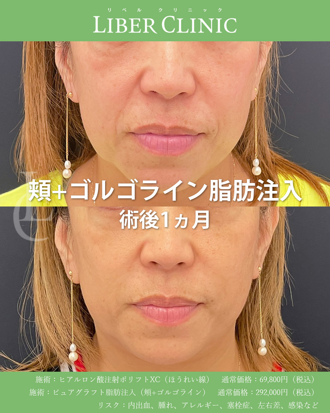 手術前と術後1ヵ月