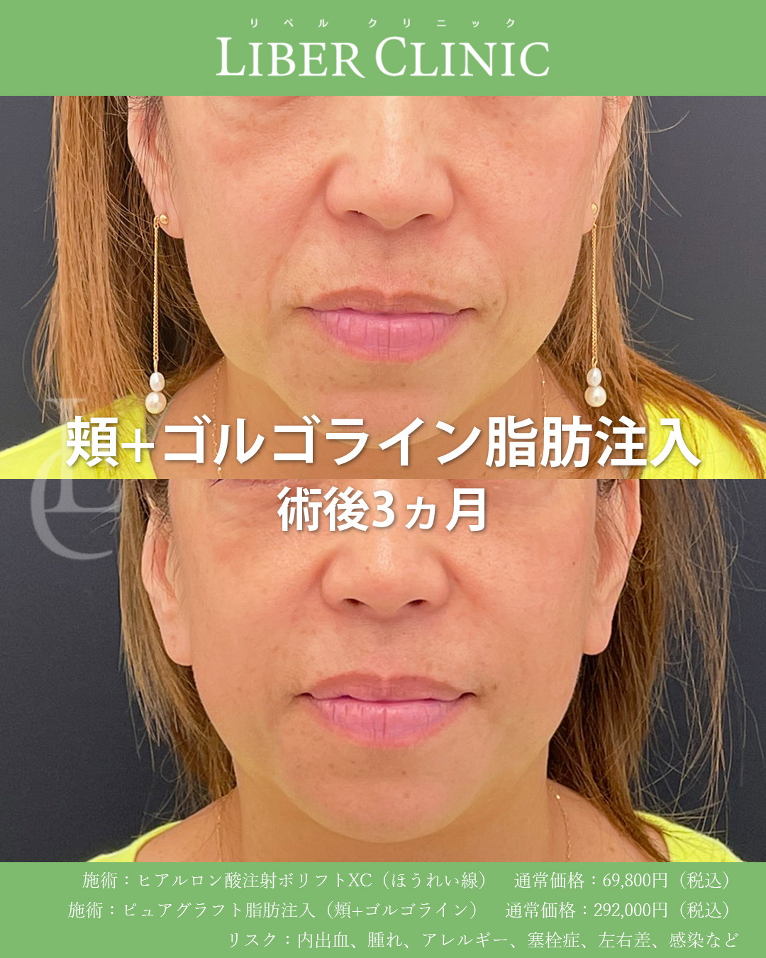 手術前と術後3ヵ月
