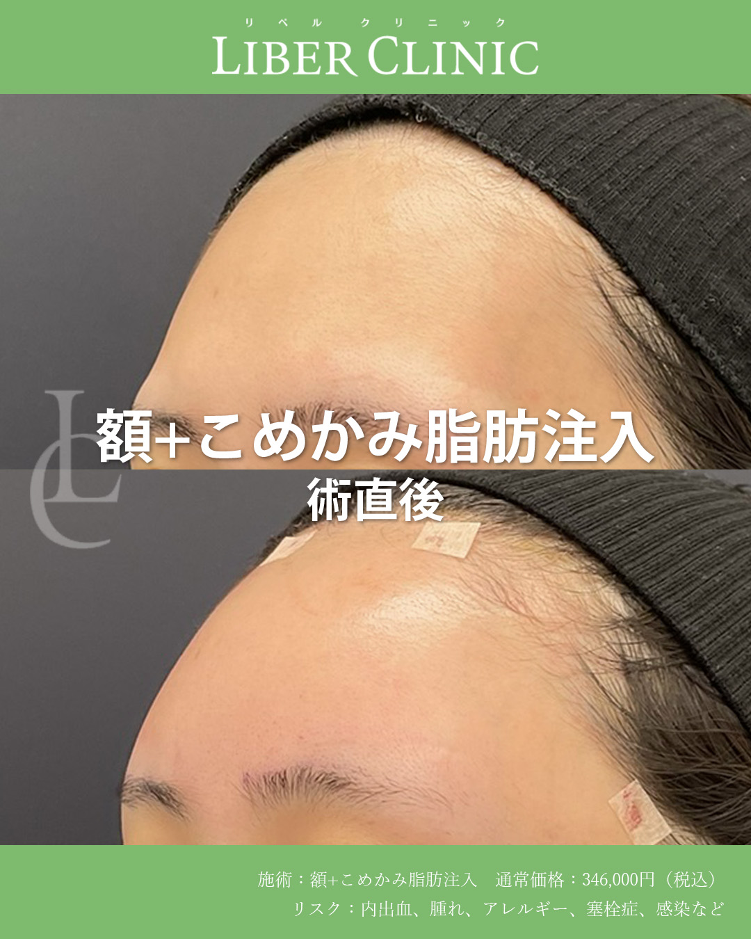 手術前と術直後