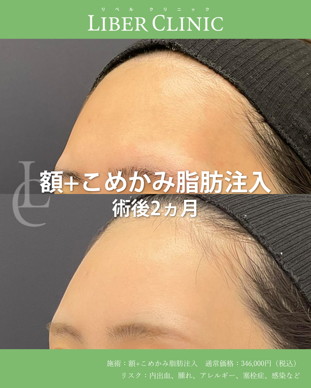 手術前と術後2ヵ月