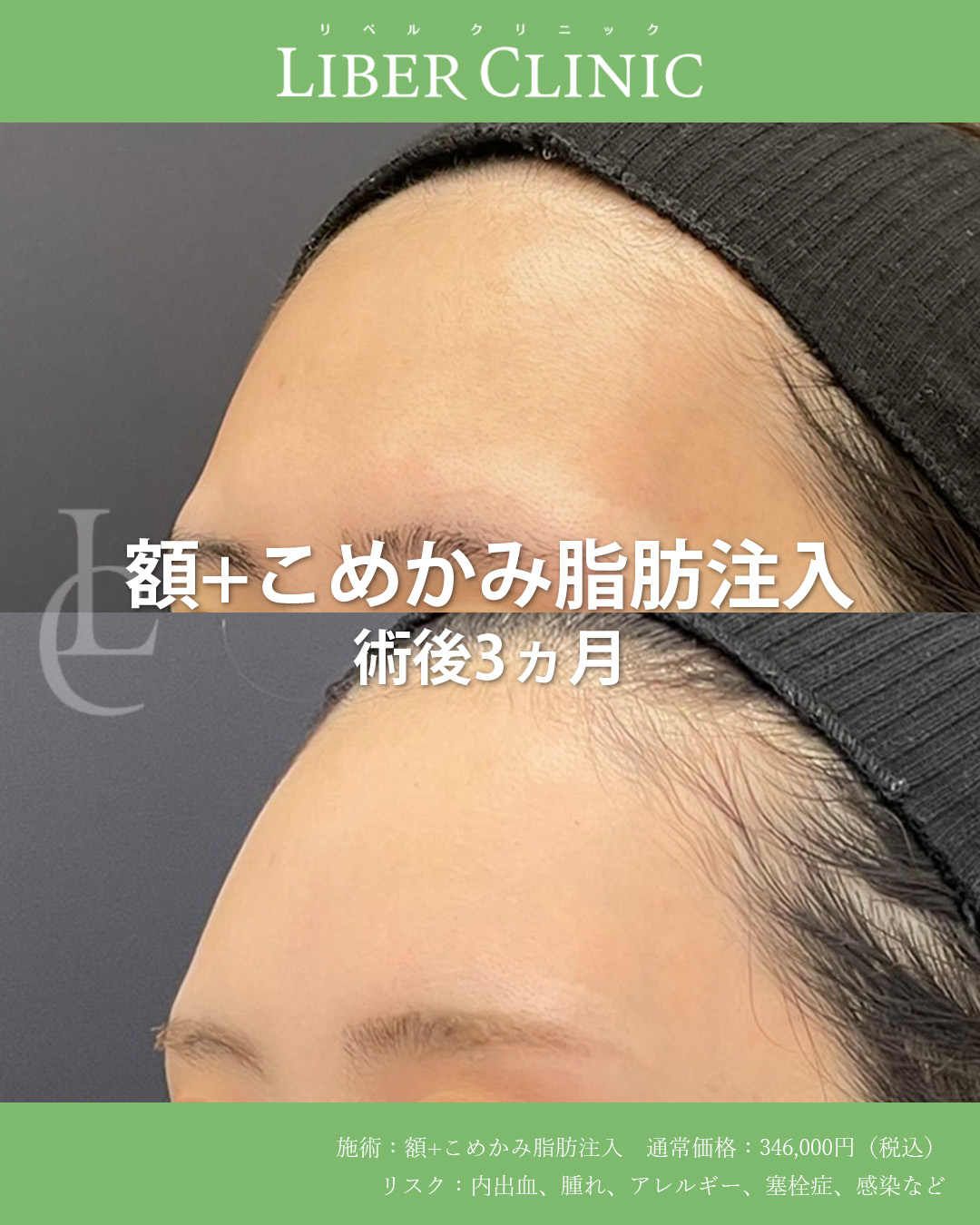 手術前と術後3ヵ月