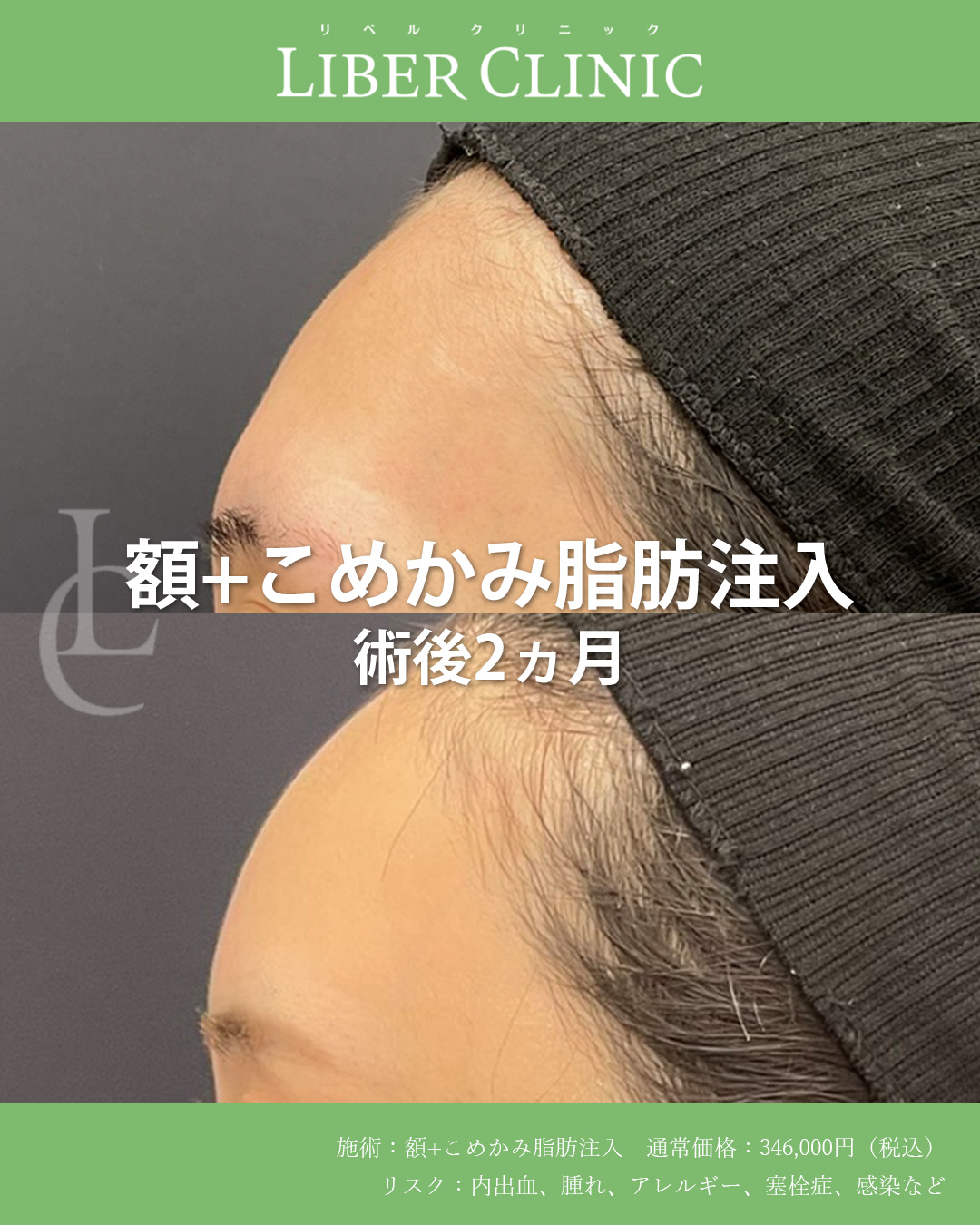 手術前と術後2ヵ月