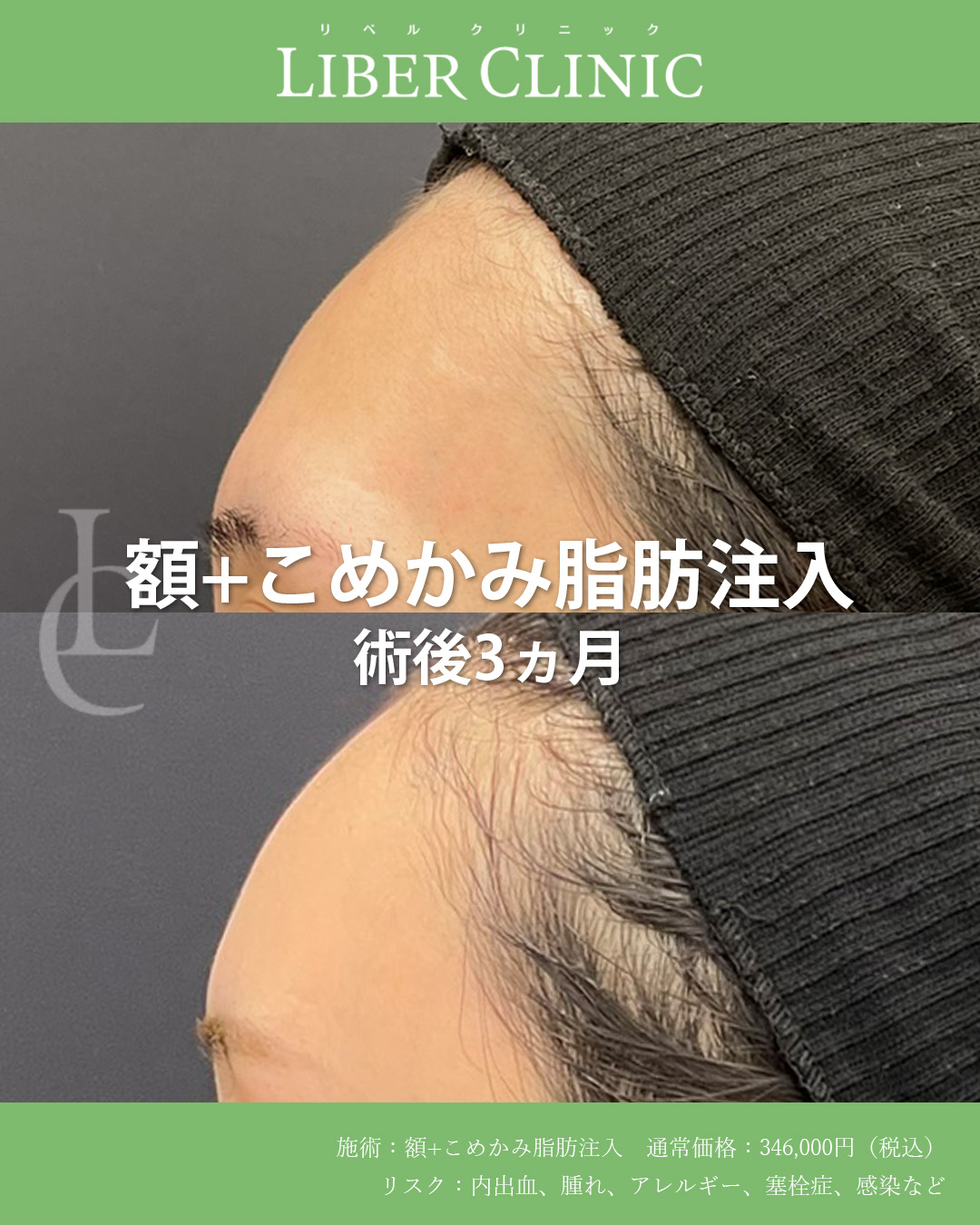 手術前と術後3ヵ月
