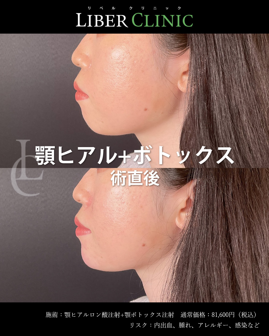 手術前と術直後