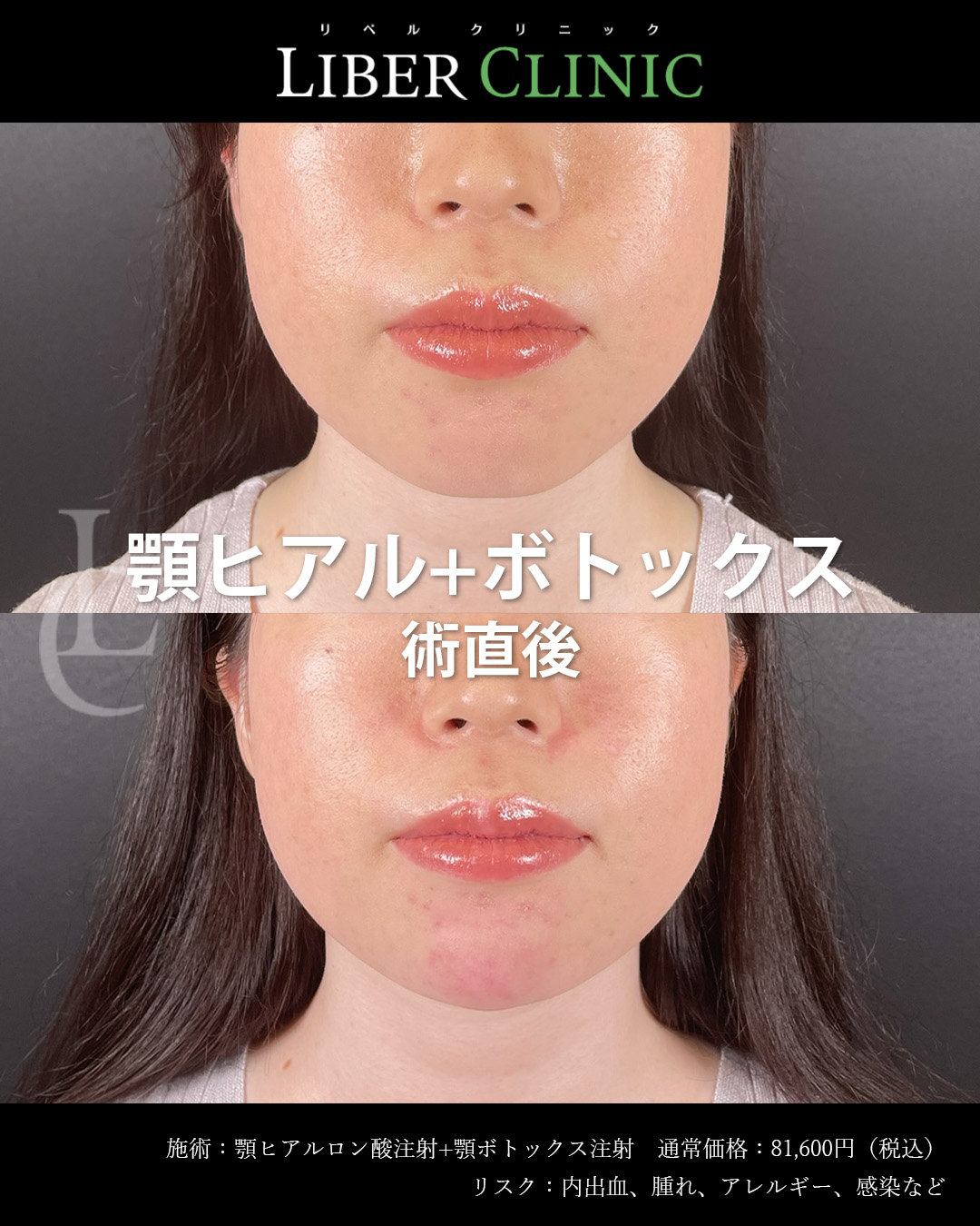 手術前と術直後