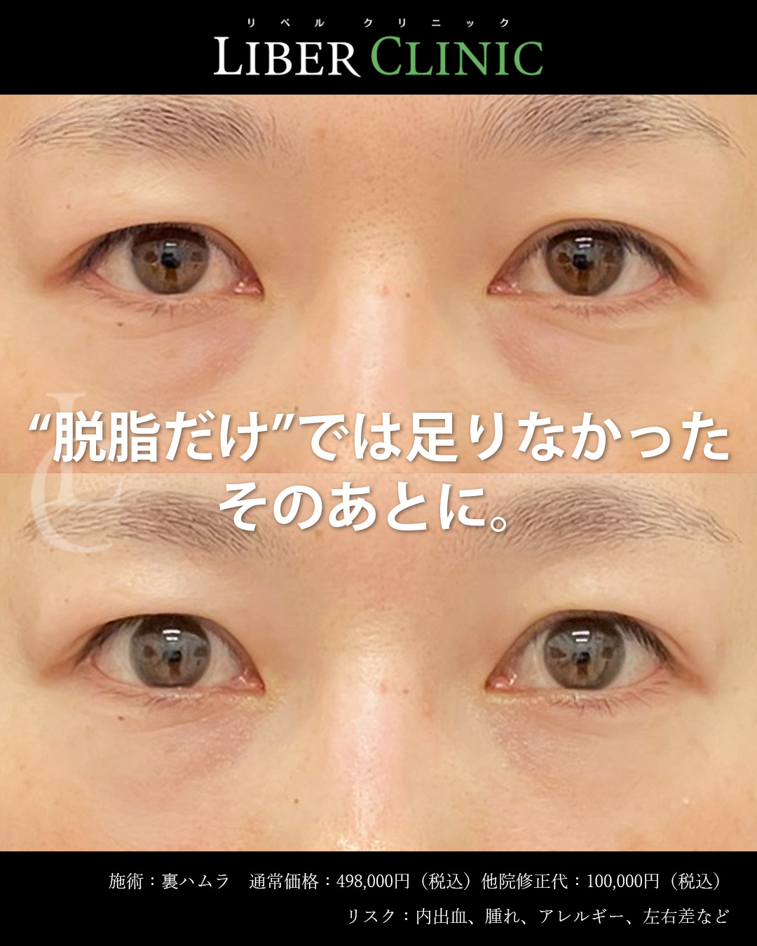 脱脂だけでは足りなかったそのあとに