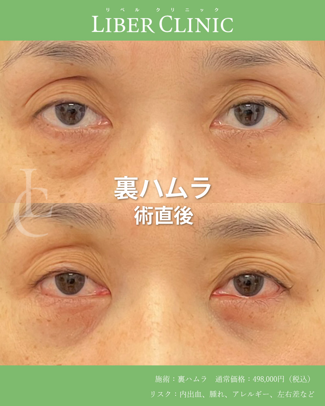 手術前と術直後