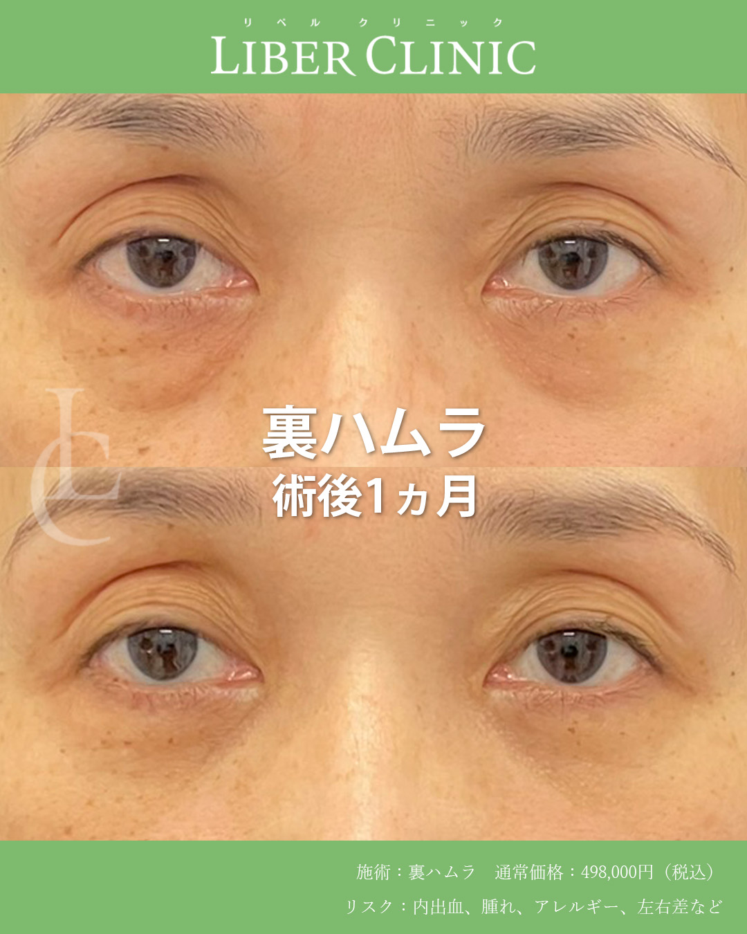 手術前と術後1ヵ月