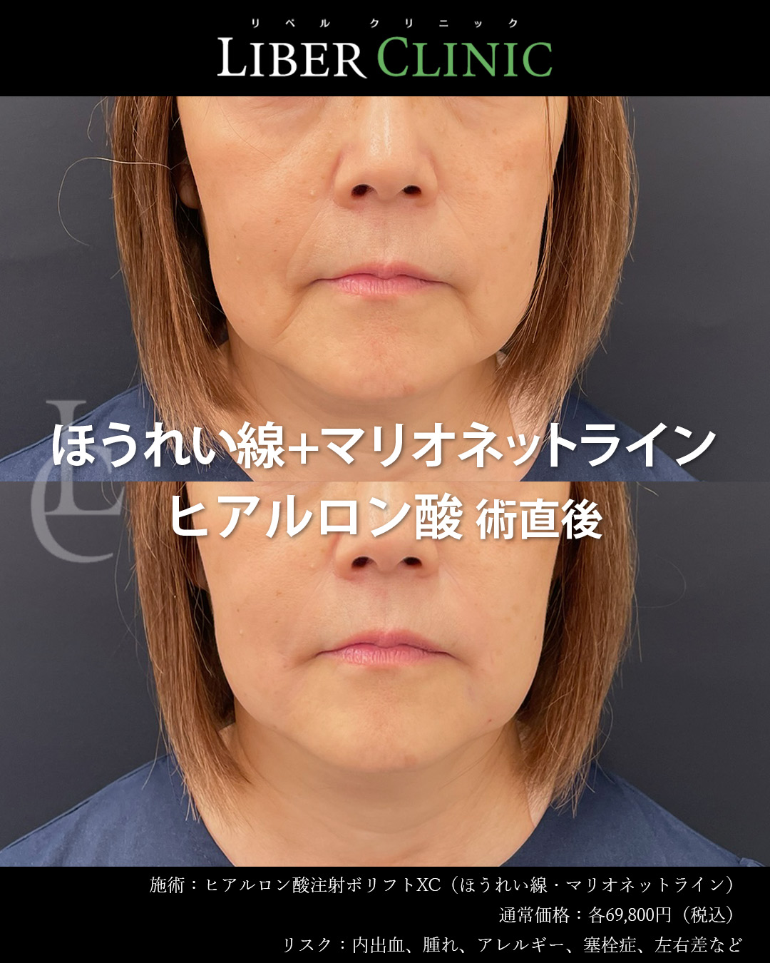 手術前と術直後