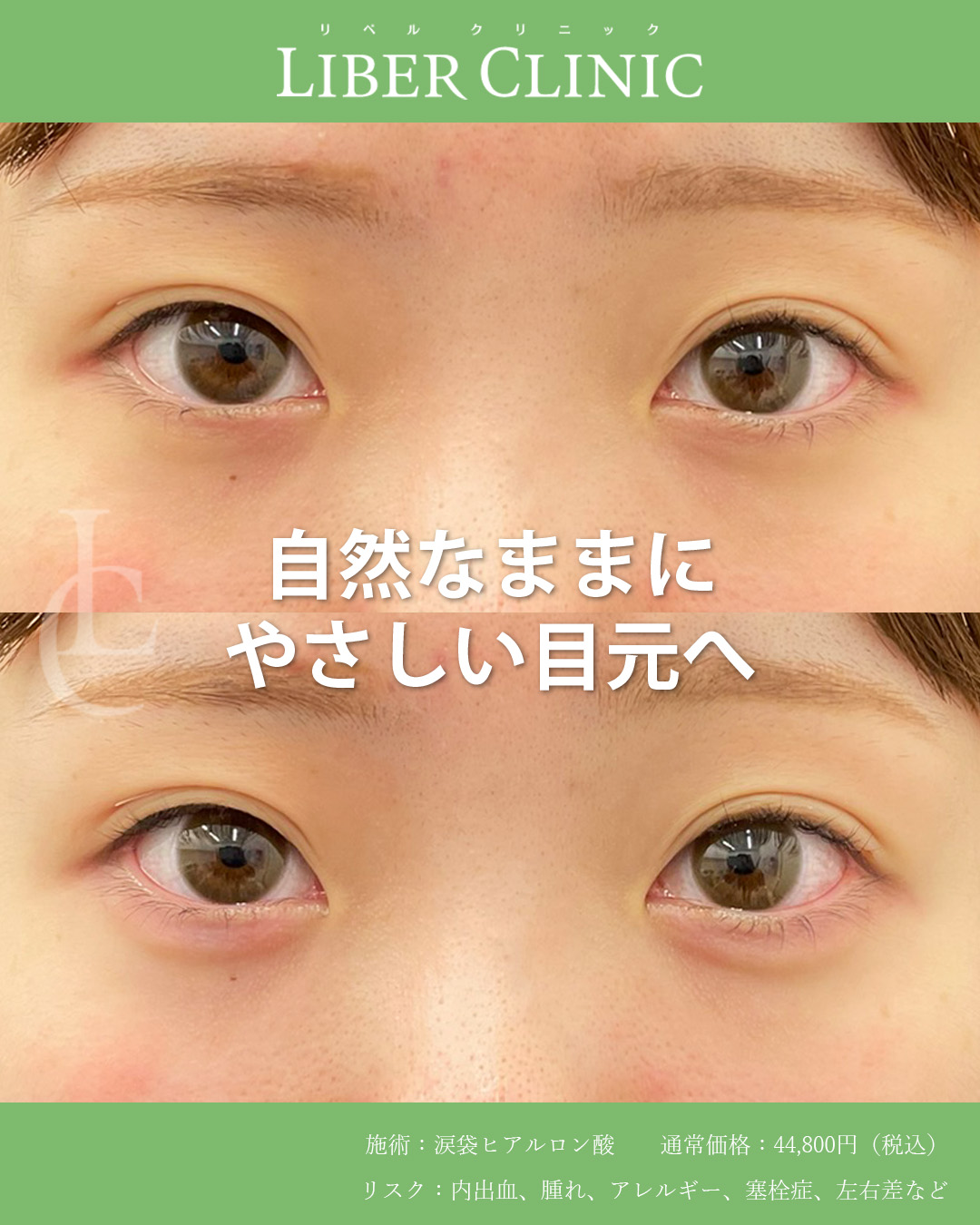 自然なままにやさしい目元へ
