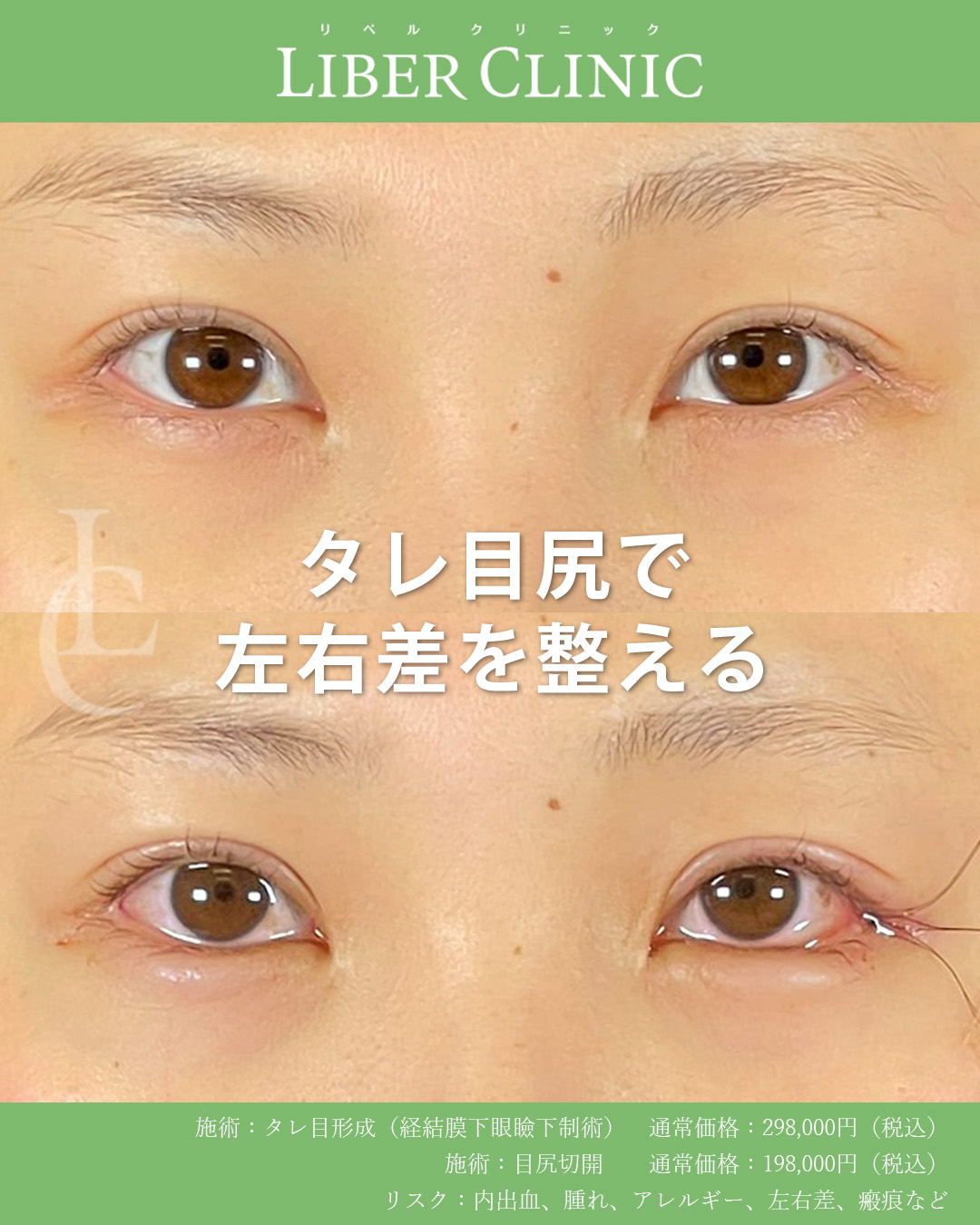 非公開: タレ目尻で左右差を整える