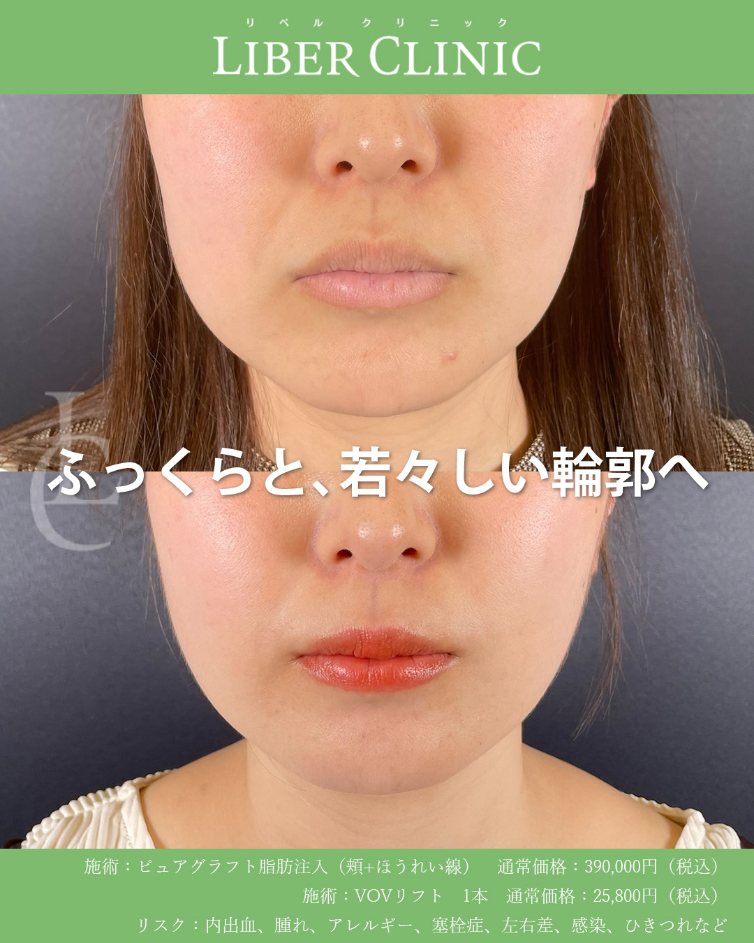 ふっくらと若々しい輪郭へ