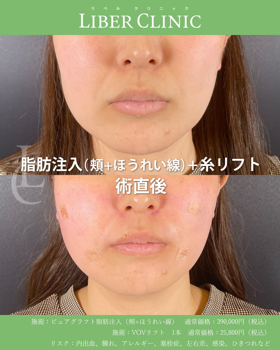 手術前と術直後