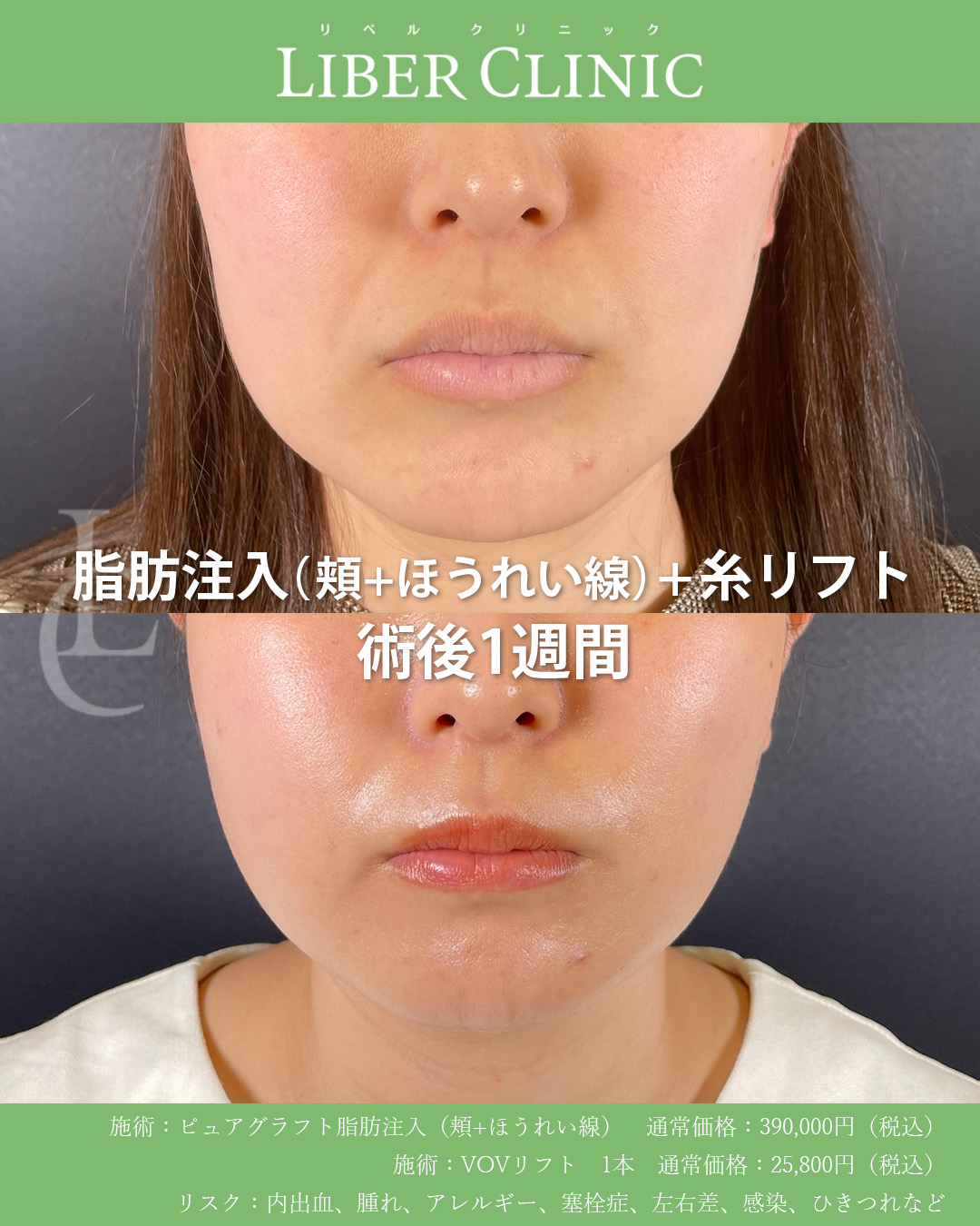 手術前と術後1週間
