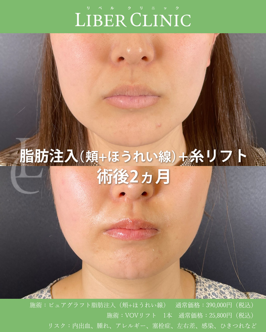 手術前と術後2ヵ月