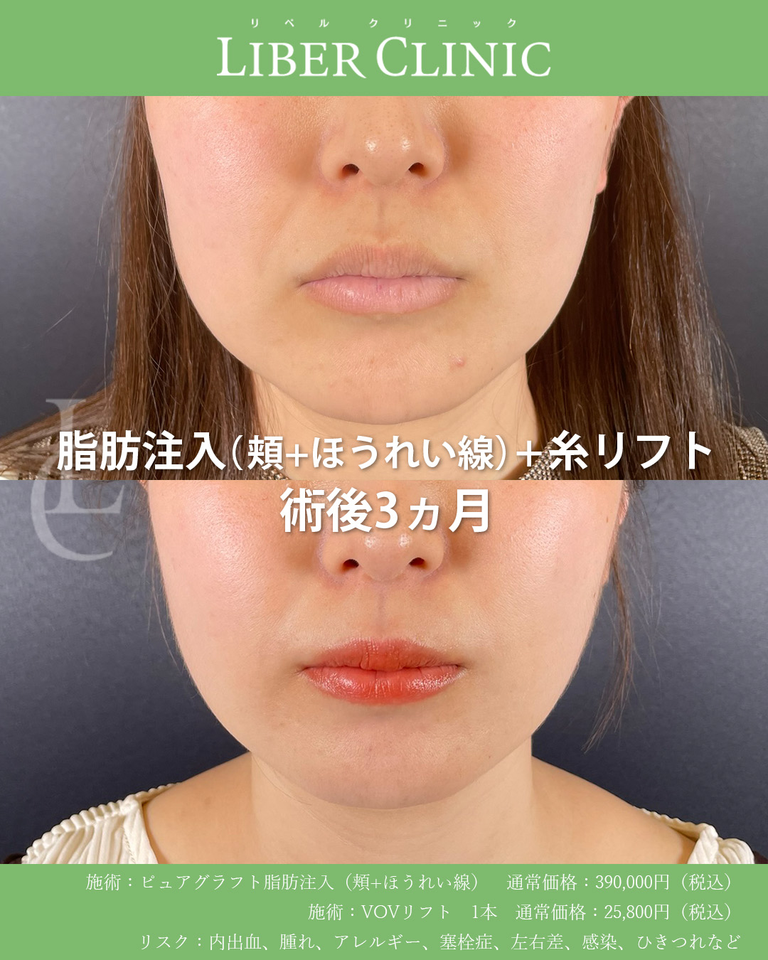 手術前と術後3ヵ月