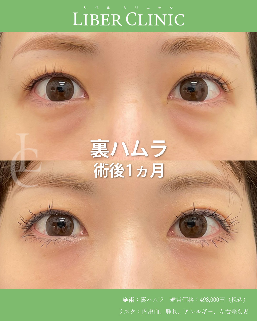 疲れて見える目元は裏ハムラでリセット