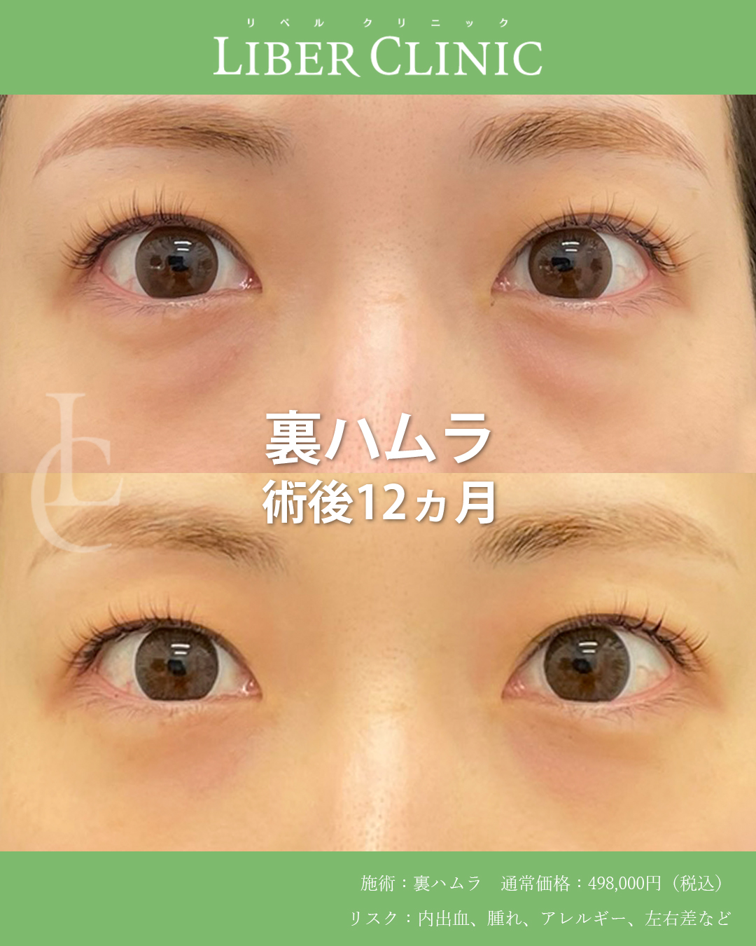 疲れて見える目元は裏ハムラでリセット