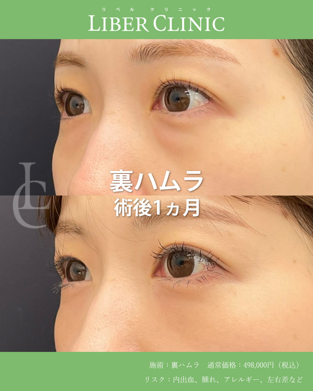 手術前と術後1ヵ月