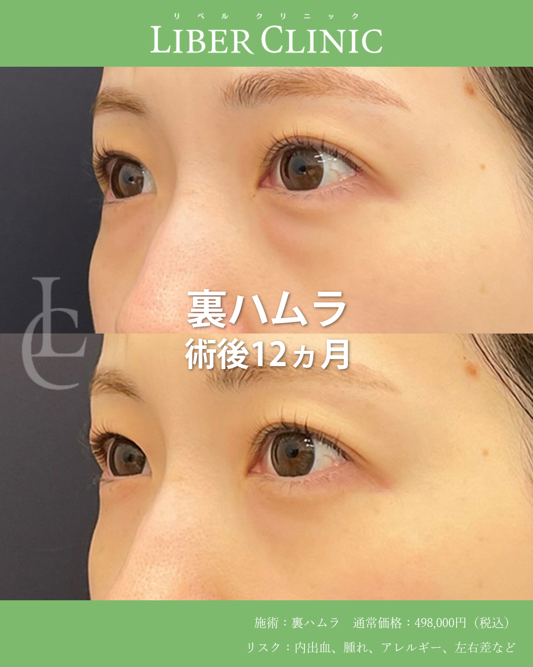 手術前と術後12ヶ月