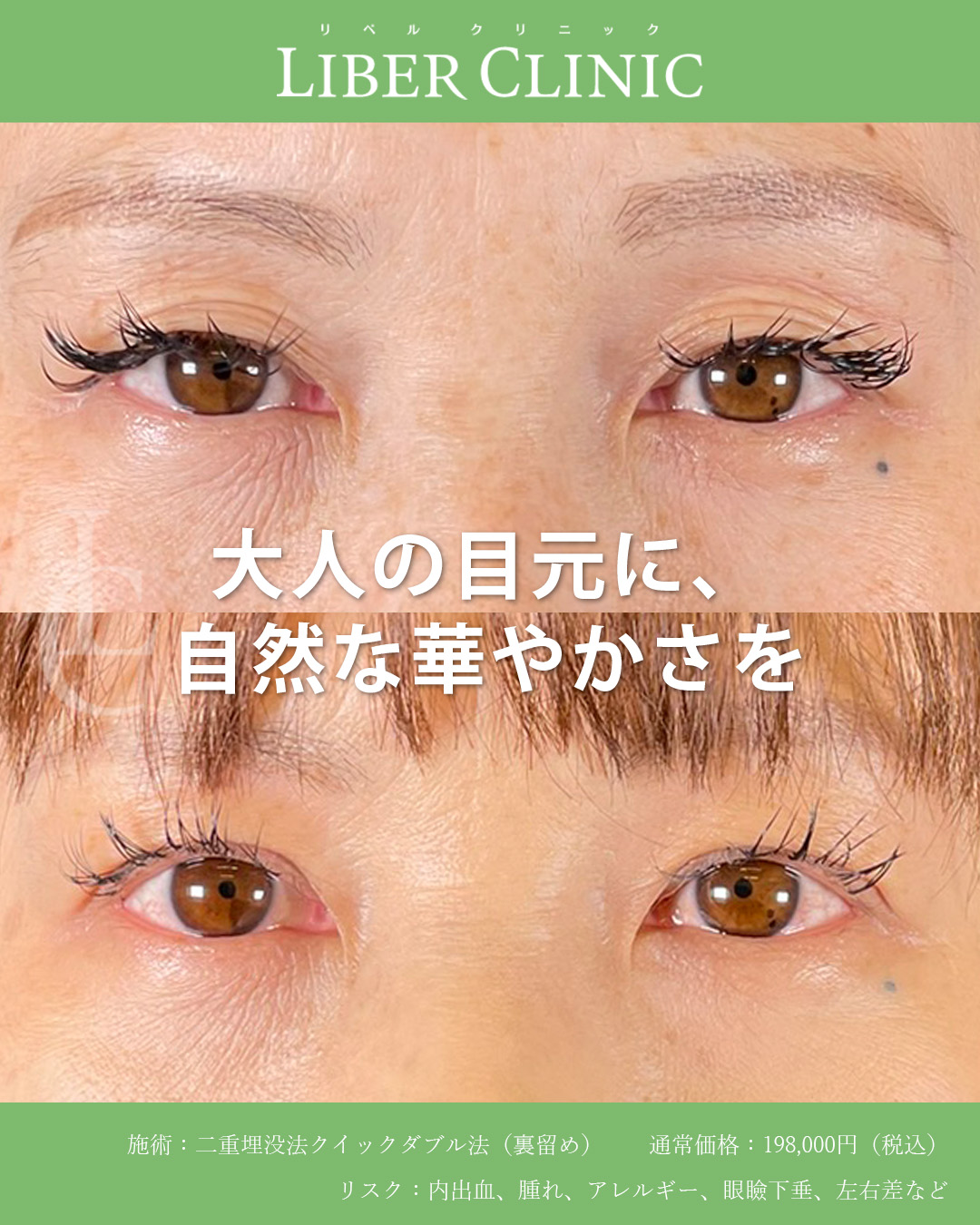 二重埋没法で大人の目元に自然な華やかさを