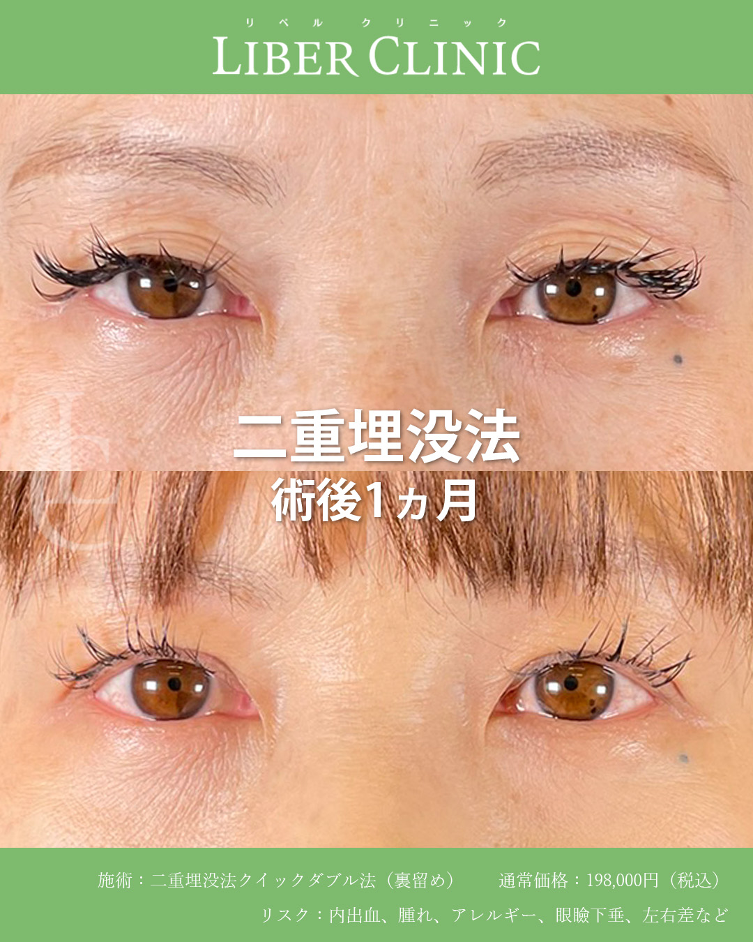 手術前と術後1ヵ月