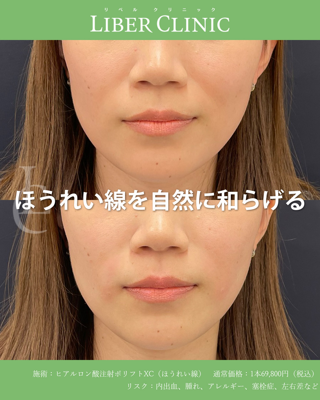 ほうれい線を自然に和らげる