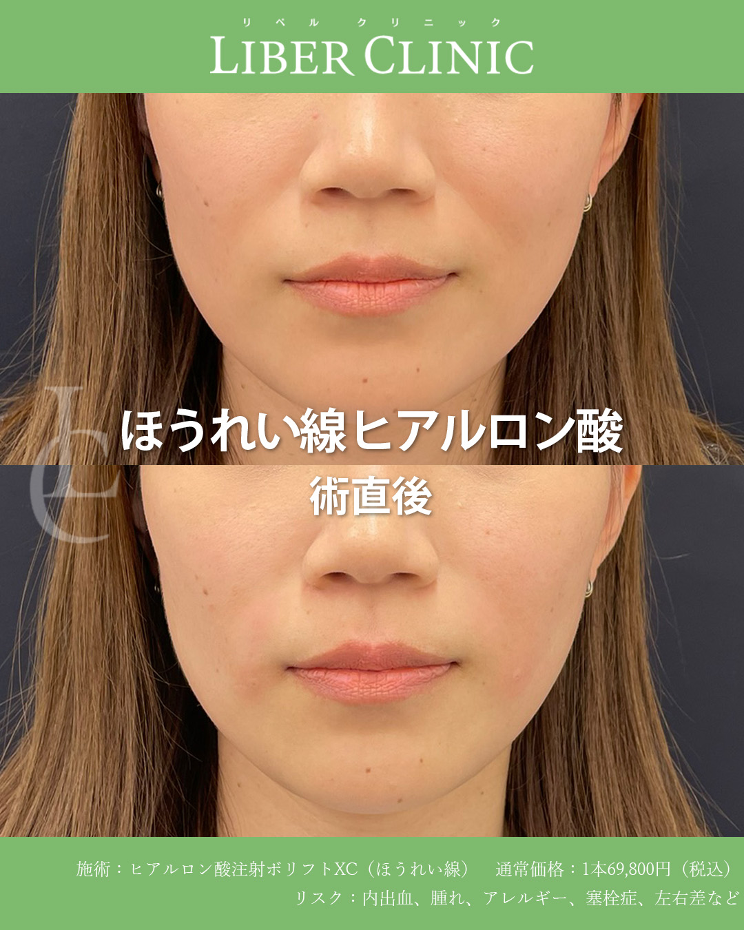 手術前と術直後
