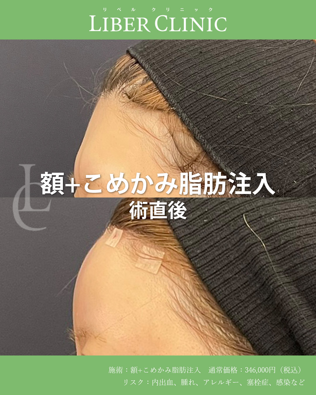 手術前と術直後
