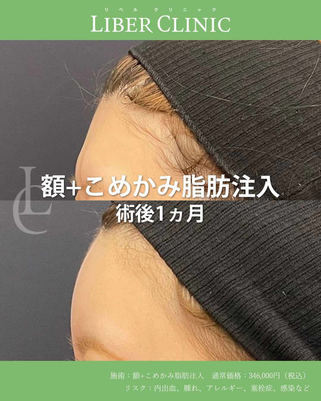 手術前と術後1ヵ月