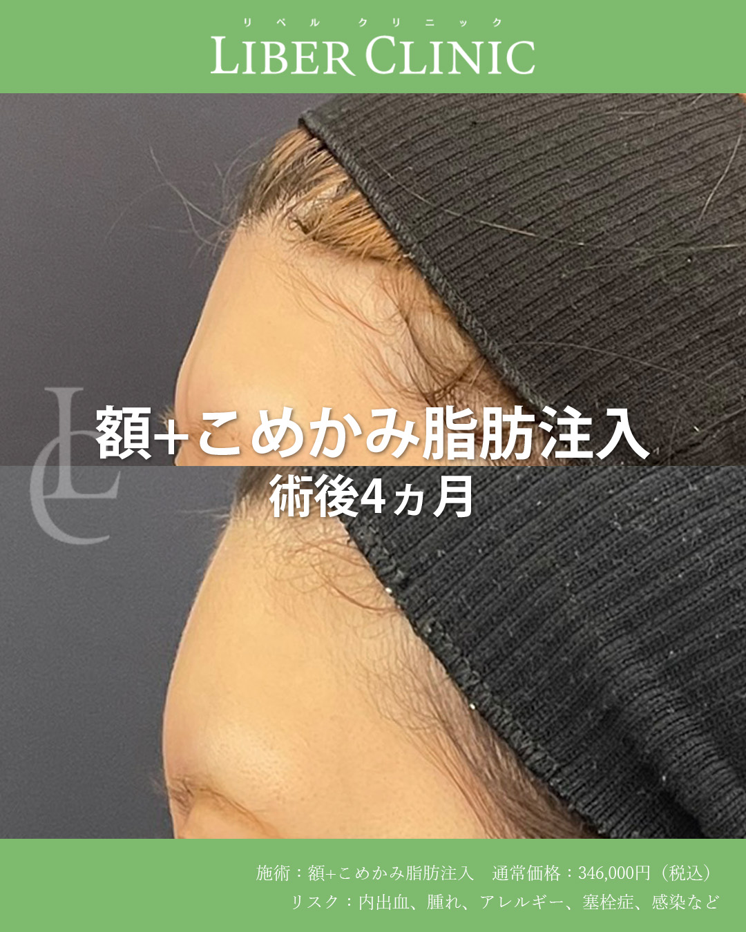 骨っぽさを和らげる脂肪注入