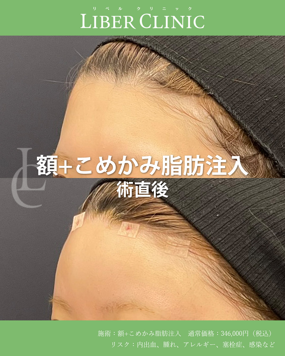手術前と術直後