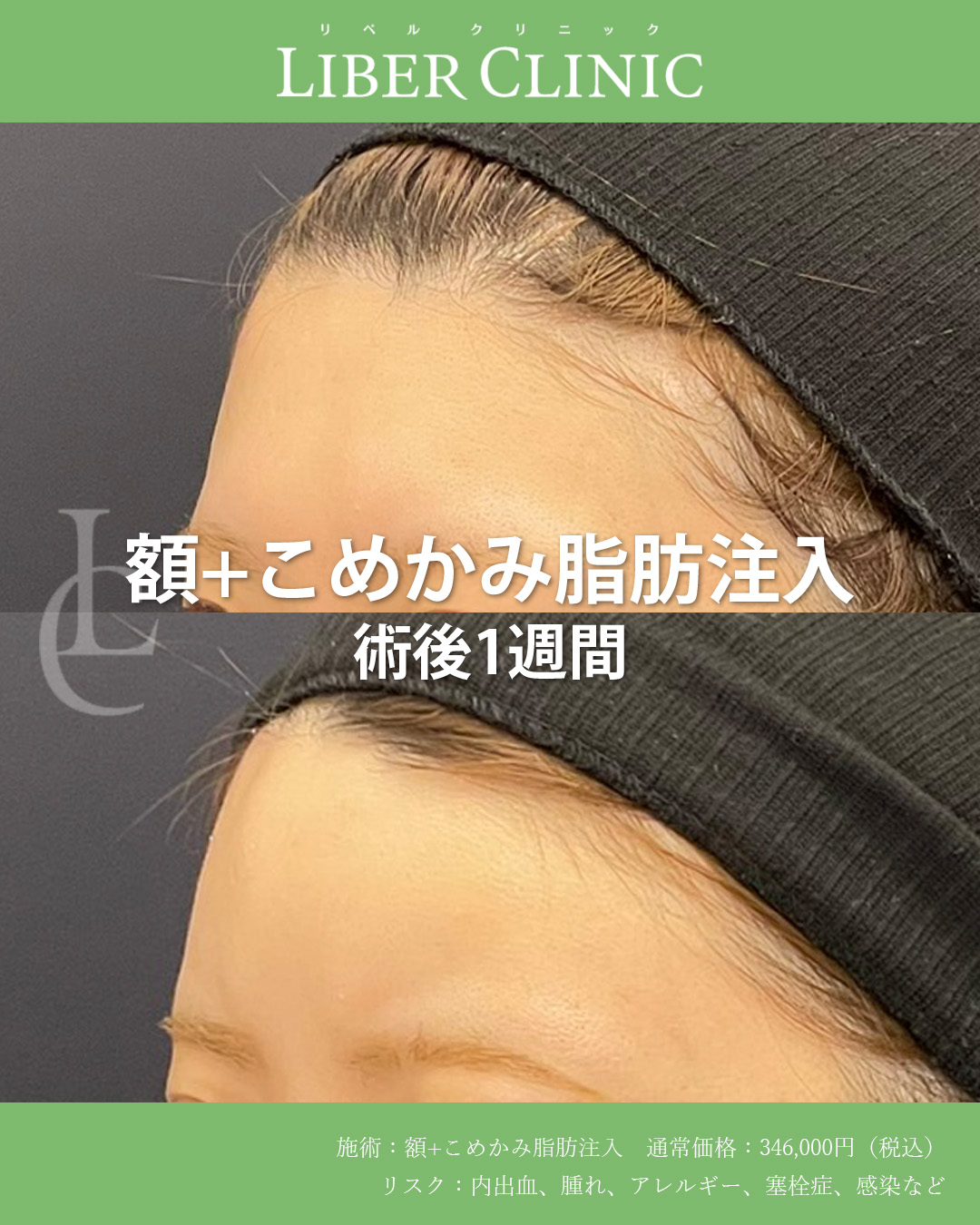 手術前と術後1週間